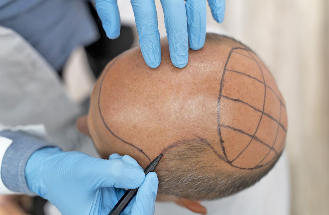 DHI Hair Transplantation