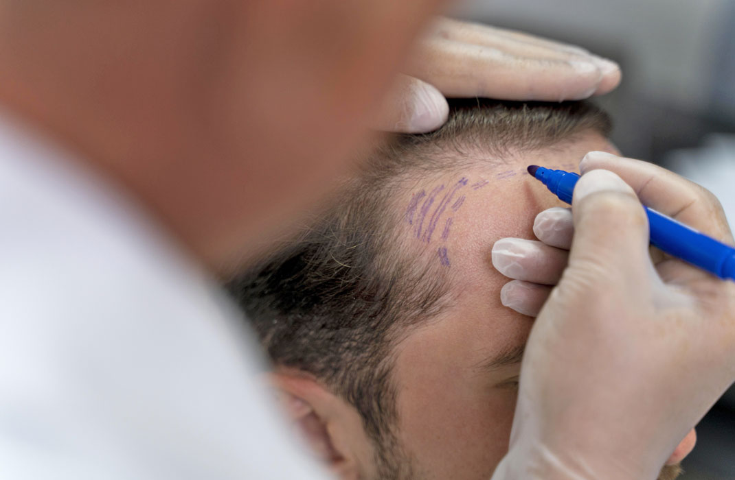 FUE Hair Transplant