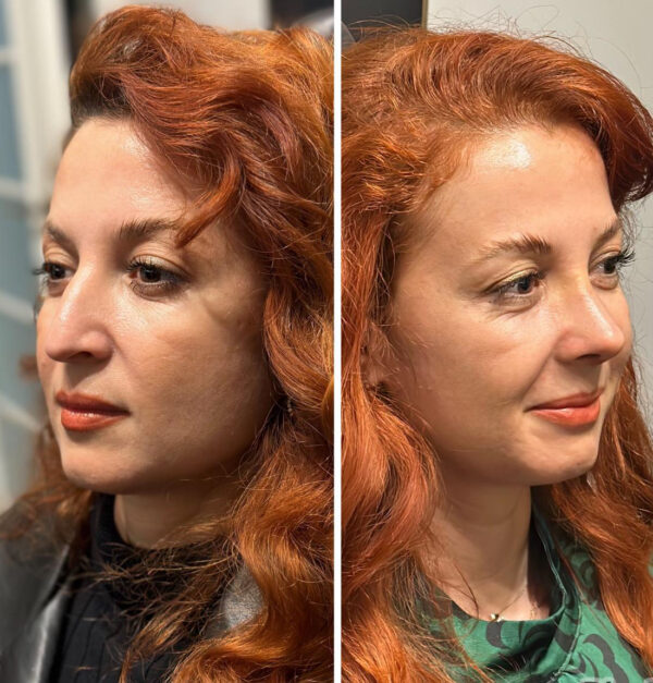 Burun-Before-After (8)