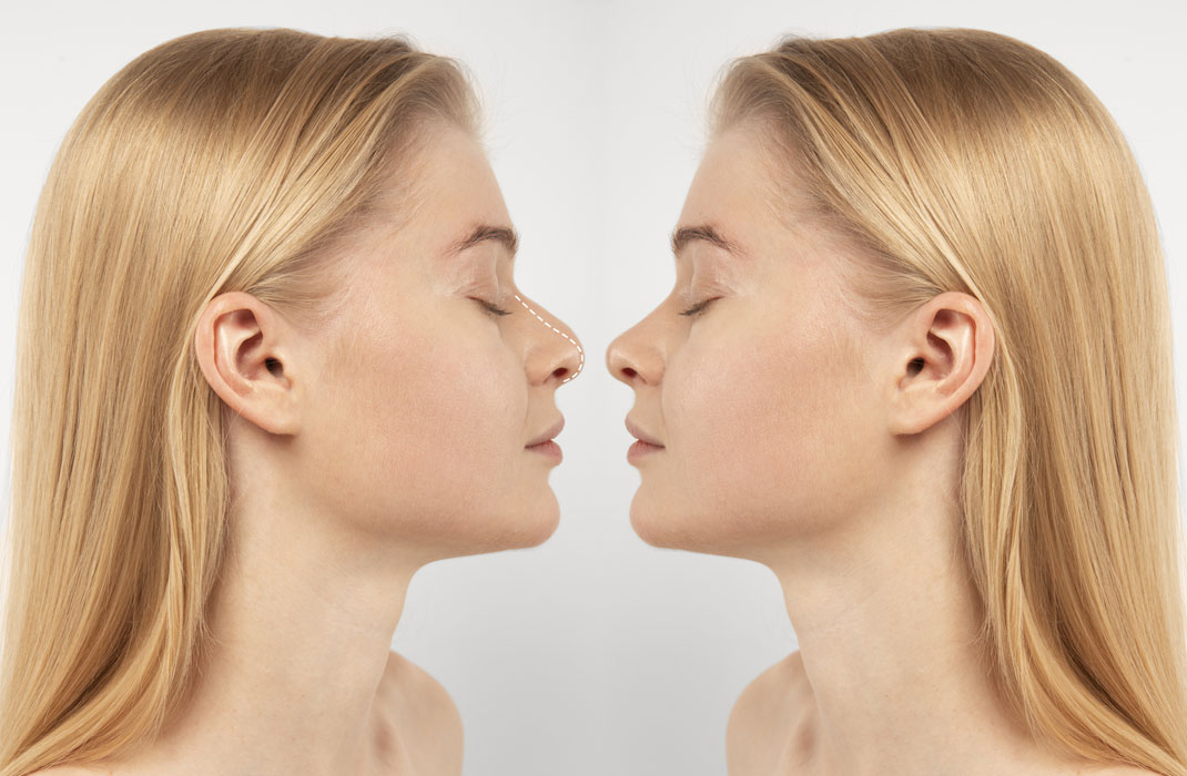 Rhinoplasty Nose Aesthetics